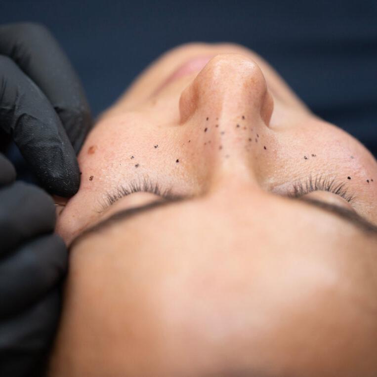 patient receiving freckle tattooing